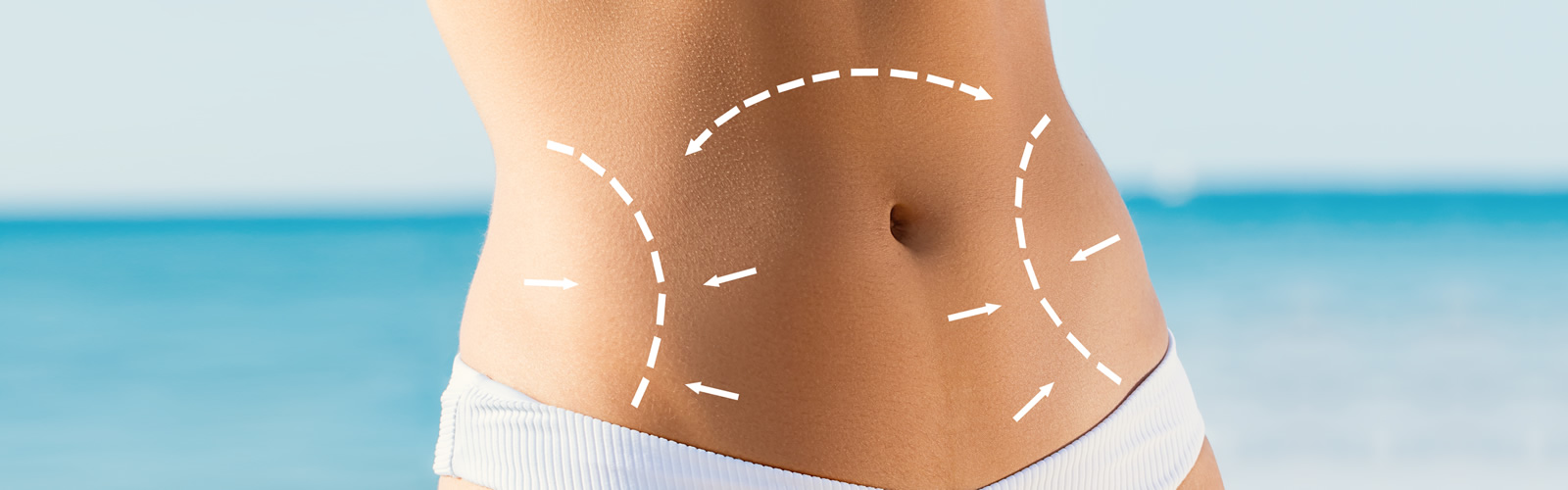 Abdominoplastia para corregir una hernia Umbilical - Clínica